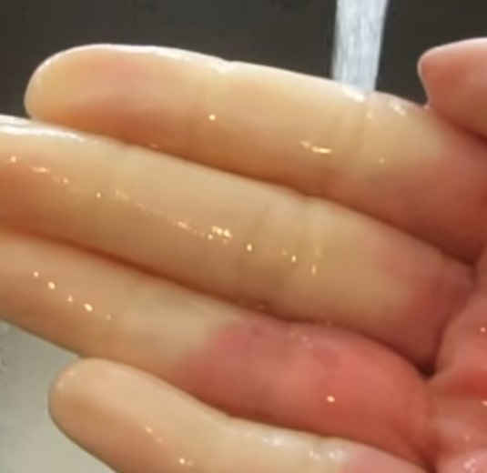 Hand With Raynauds